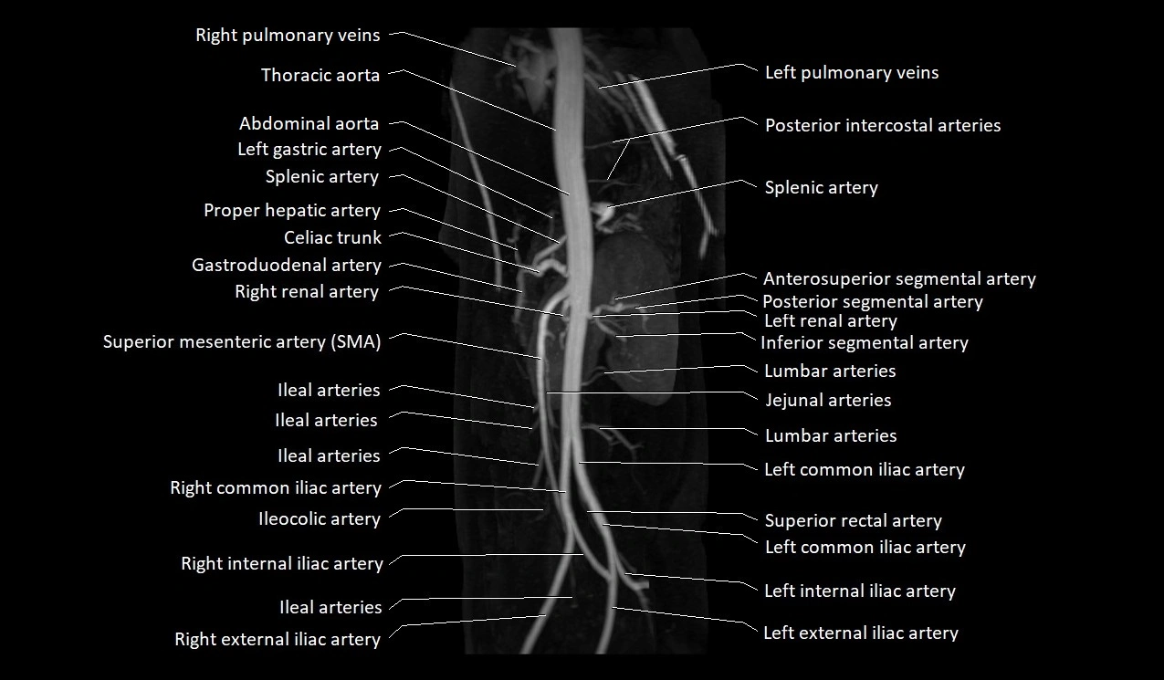 MRA abdomen (renal and mesenteric) angiography MIP 3D anatomy image 5.webp